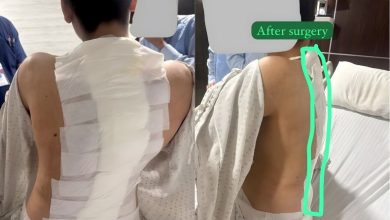 spine surgery - Pakistani Team Performs Complex Spine Surgery