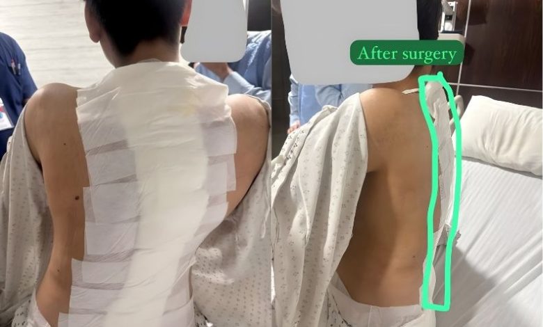 spine surgery - Pakistani Team Performs Complex Spine Surgery